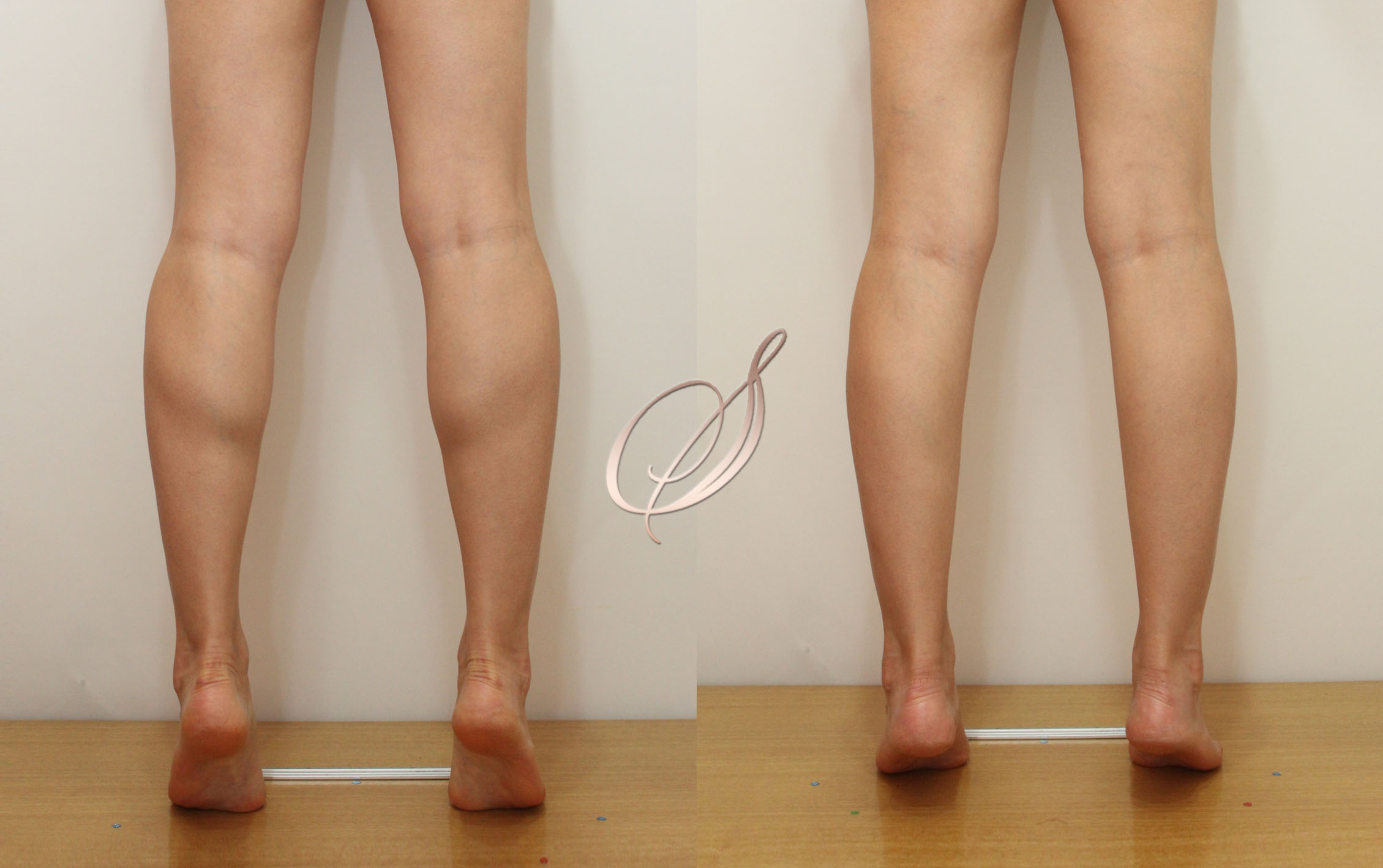 쫑알주사 — 매끈한 라인