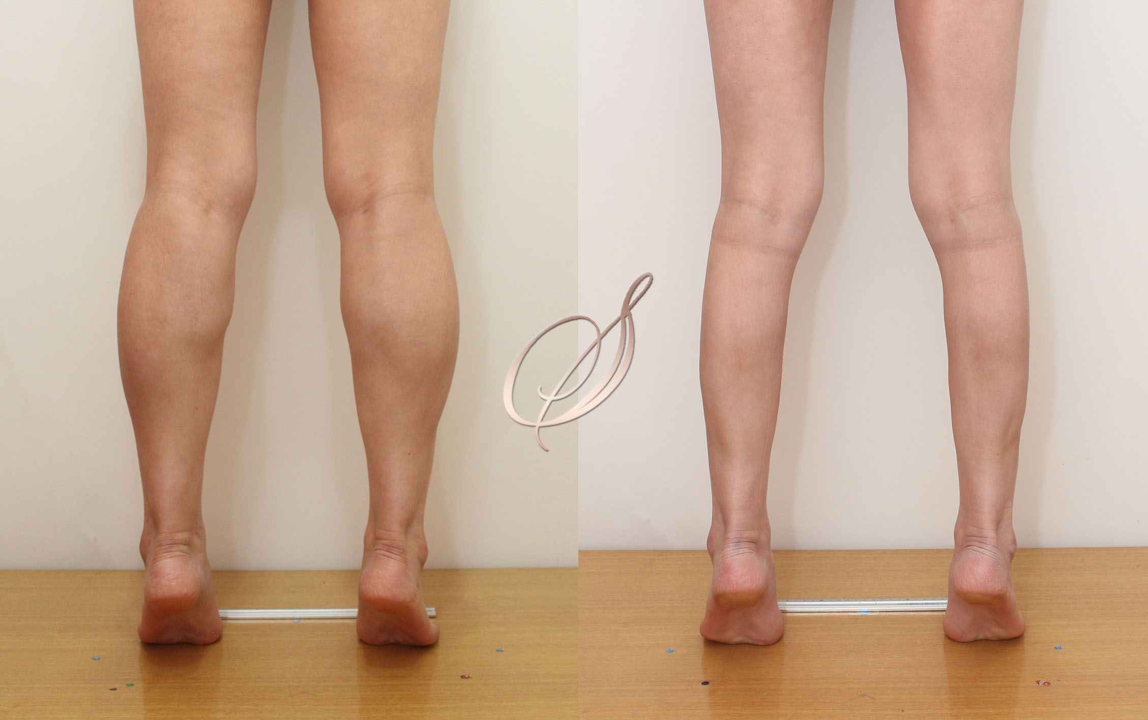 쫑알주사 — 각선미 완성