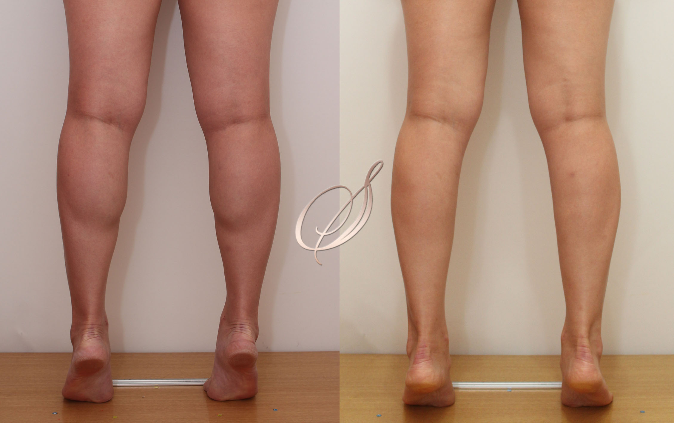 쫑알주사 — 날씬한 종아리