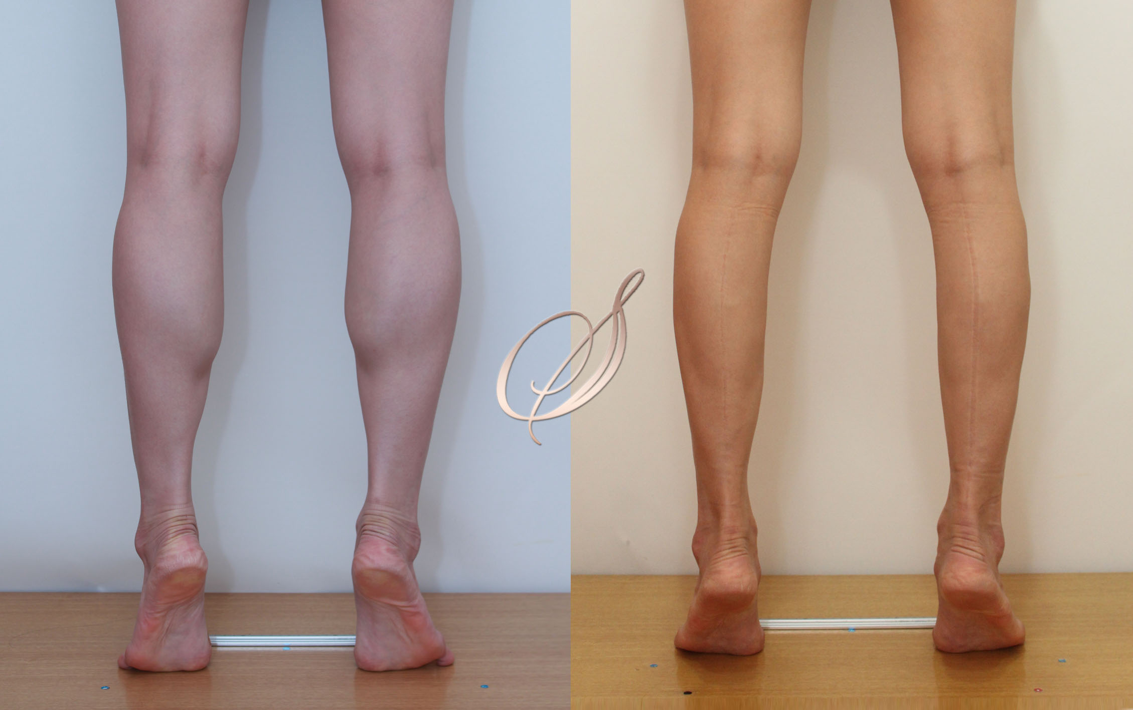 쫑알주사 — 균형잡힌 다리