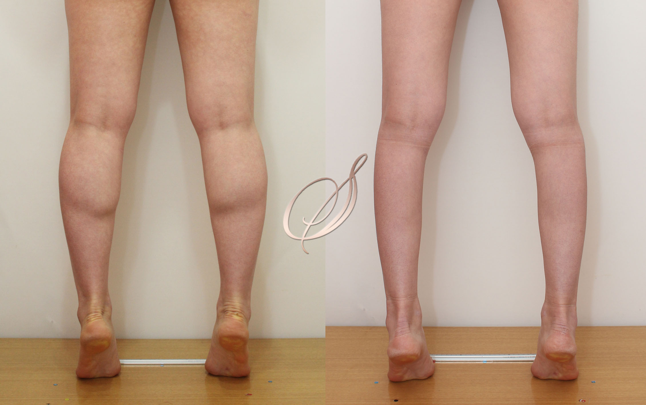 쫑알주사 — 자연스러운 라인