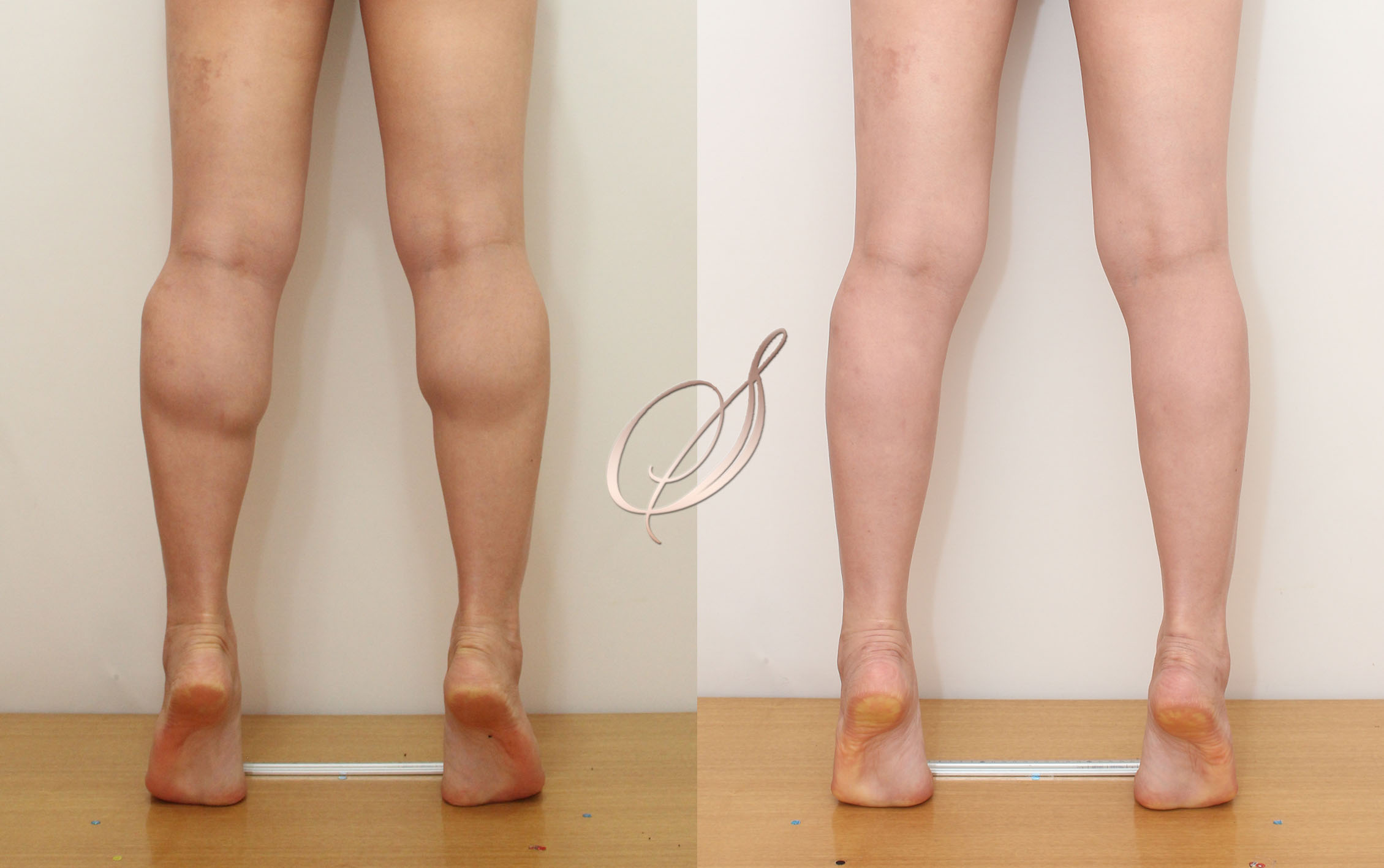 쫑알주사 — 매끈한 라인