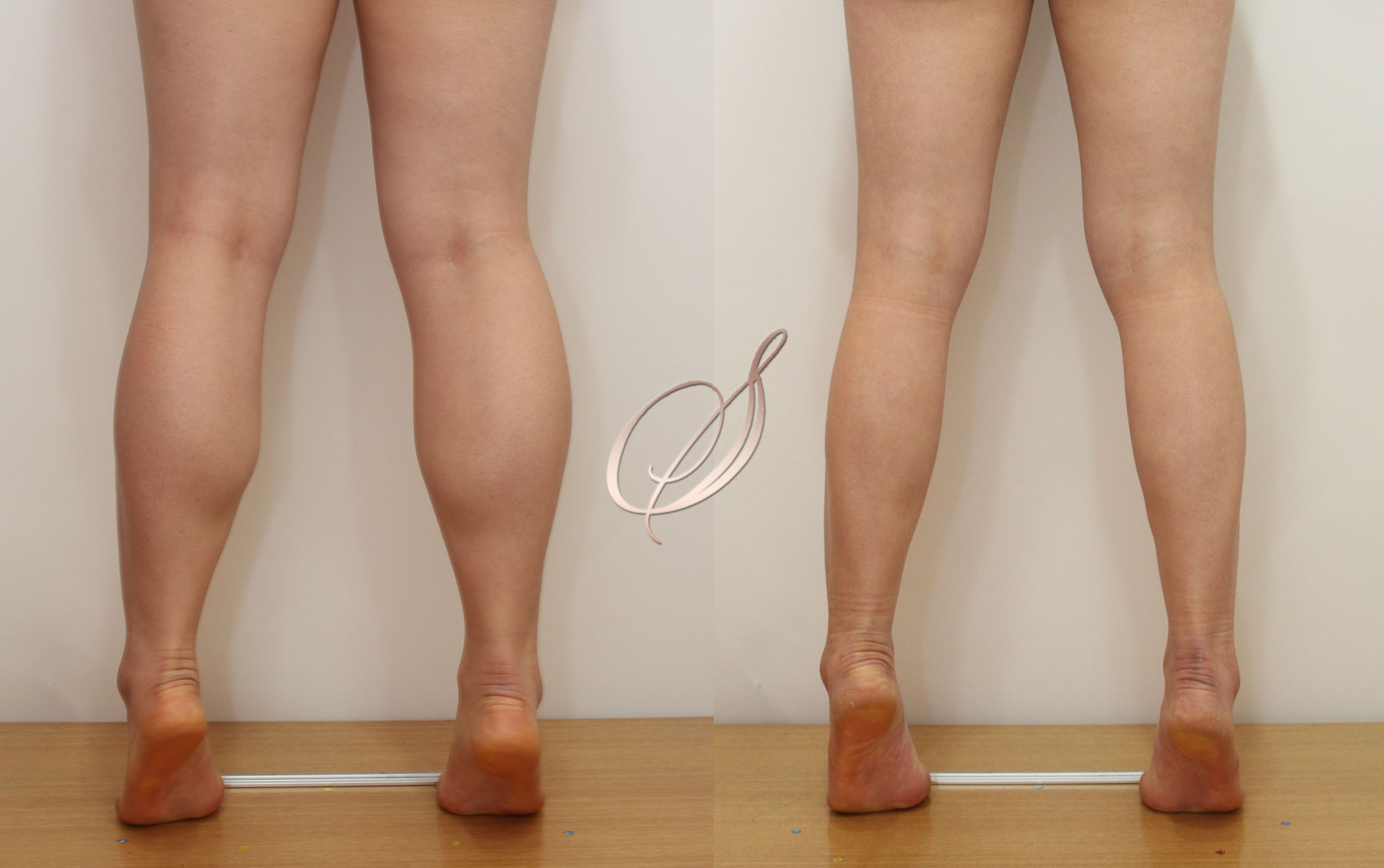 쫑알주사 — 자연스러운 변화