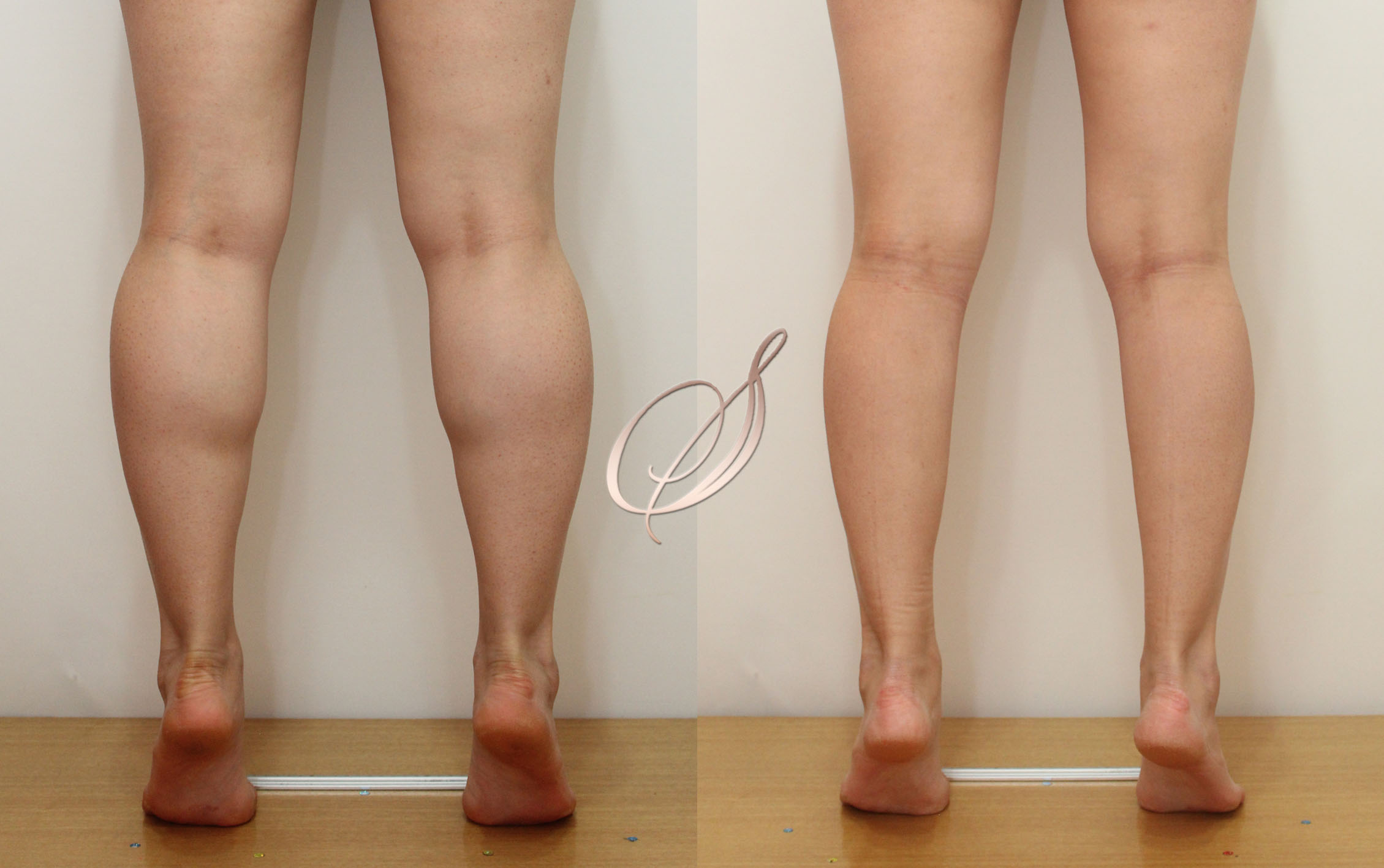 쫑알주사 — 종아리 알 축소