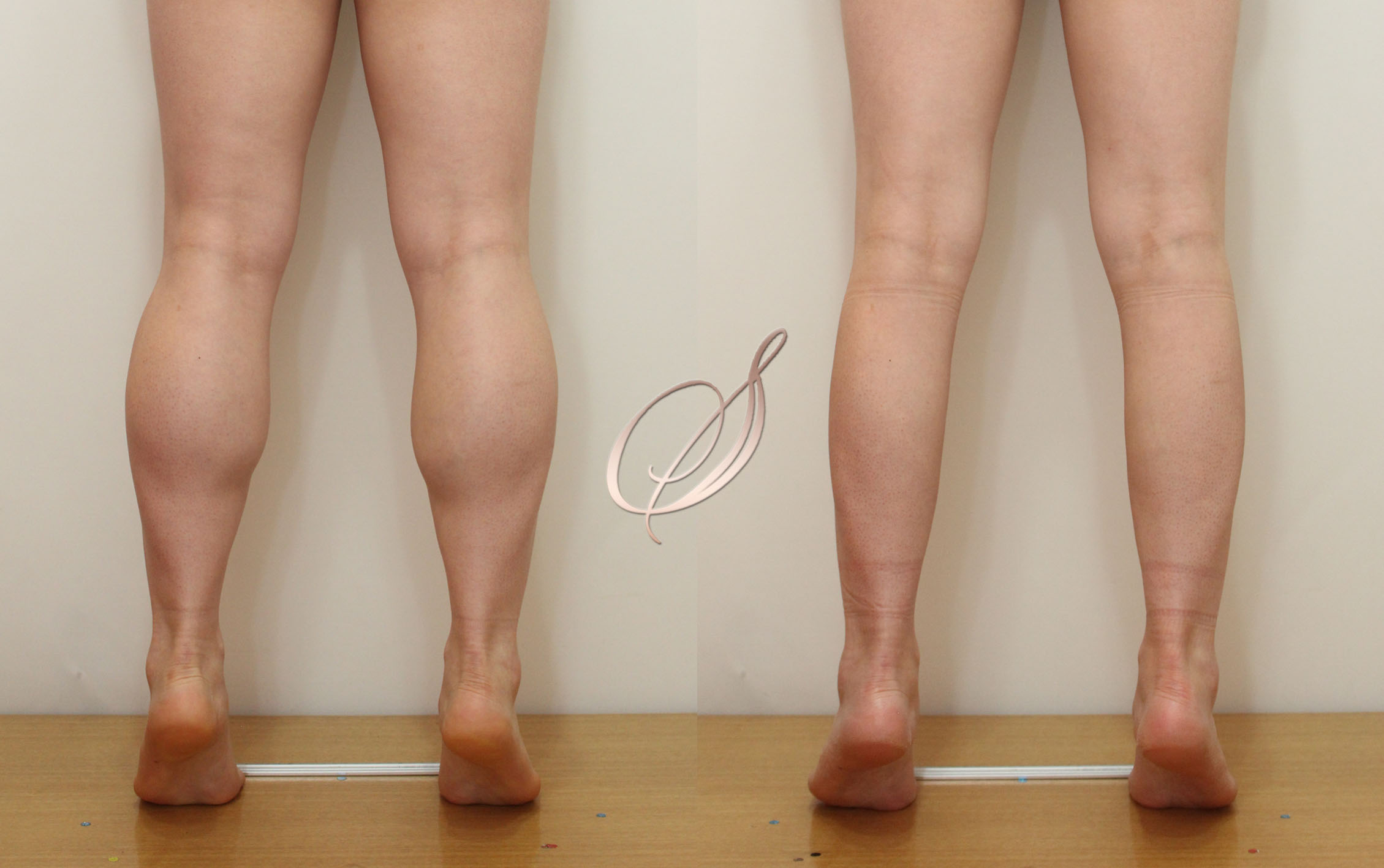 쫑알주사 — 부종 개선