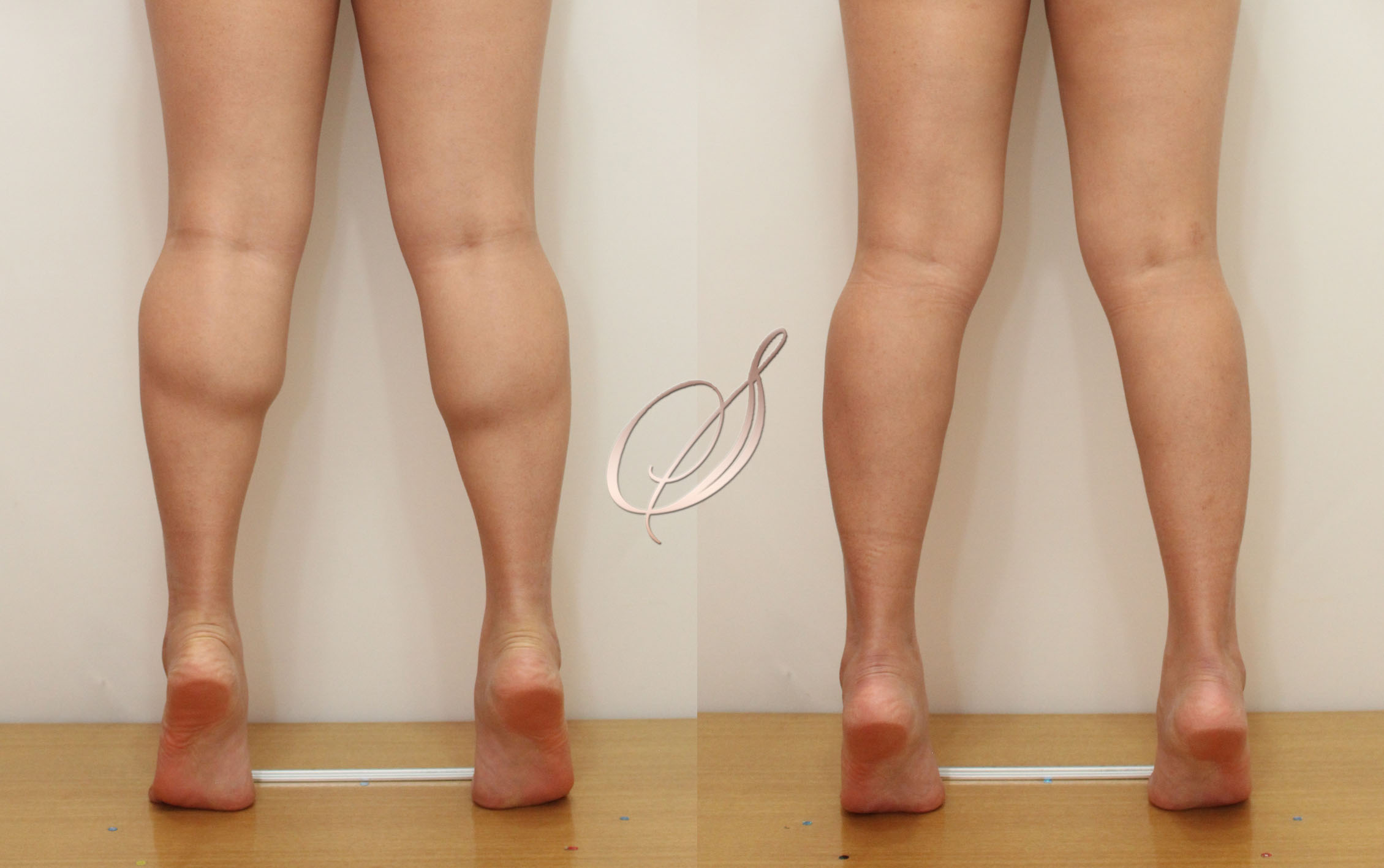 쫑알주사 — 슬림한 라인